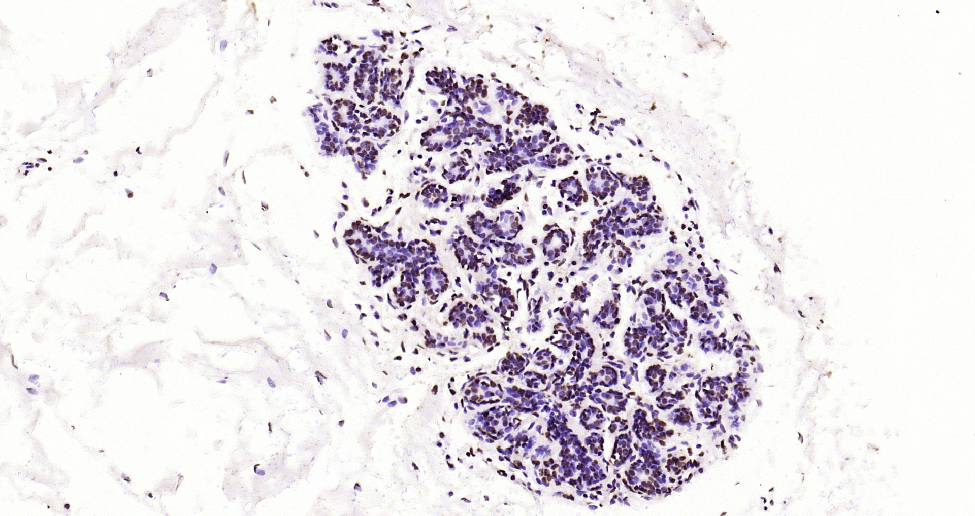 Paraformaldehyde-fixed, paraffin embedded Human breast; Antigen retrieval by boiling in sodium citrate buffer (pH6.0) for 15min; Block endogenous peroxidase by 3% hydrogen peroxide for 20 minutes; Blocking buffer (normal goat serum) at 37°C for 30min; Antibody incubation with Histone H3(di methyl K36) Monoclonal Antibody, Unconjugated (bsm-33124M) at 1:2000 overnight at 4°C, DAB staining.