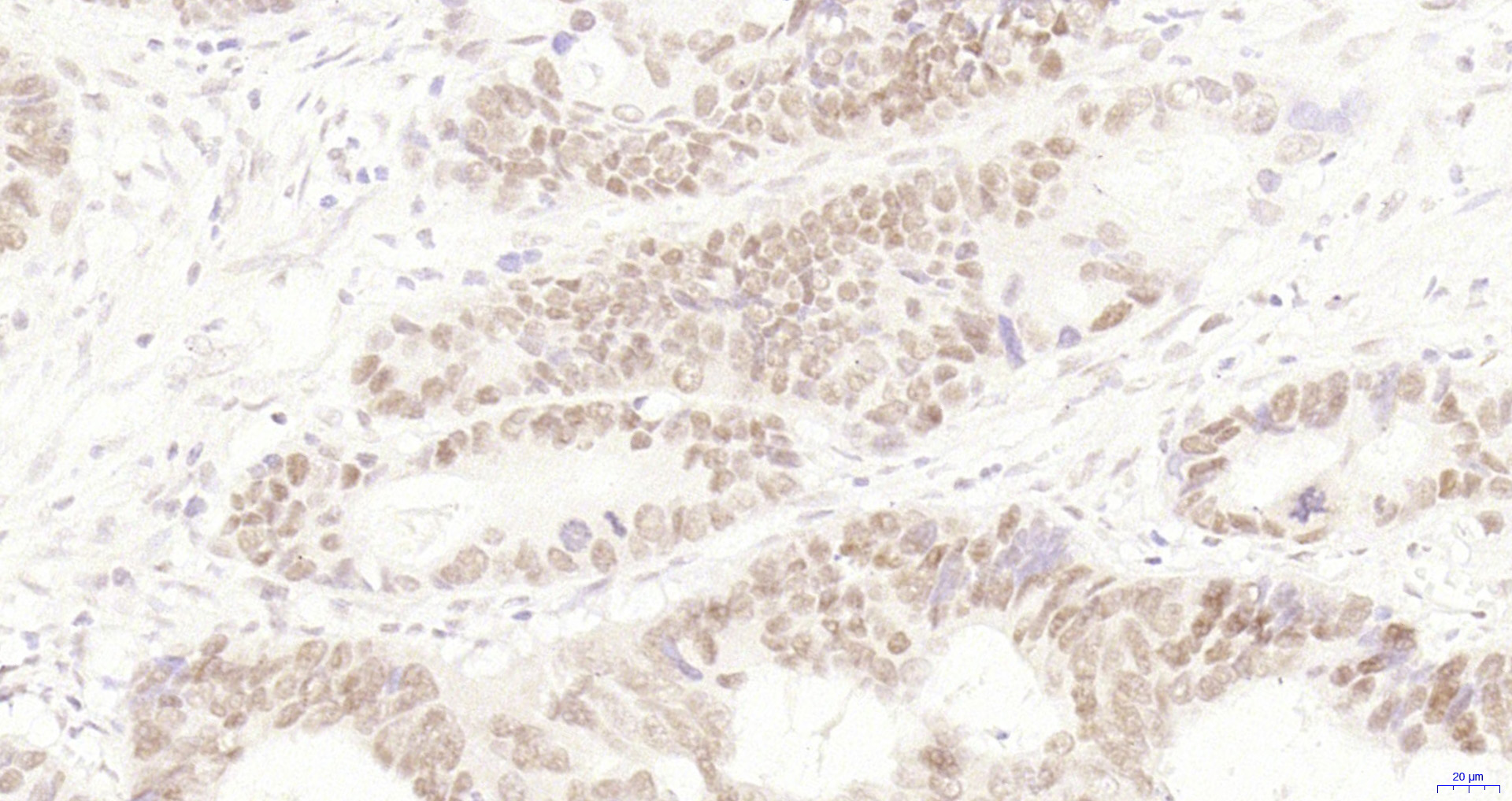 Paraformaldehyde-fixed, paraffin embedded Human rectal cancer; Antigen retrieval by boiling in sodium citrate buffer (pH6.0) for 15min; Block endogenous peroxidase by 3% hydrogen peroxide for 20 minutes; Blocking buffer (normal goat serum) at 37°C for 30min; Antibody incubation with HP1 gamma Monoclonal Antibody, Unconjugated (bsm-33375M) at 1:200 overnight at 4°C, DAB staining.