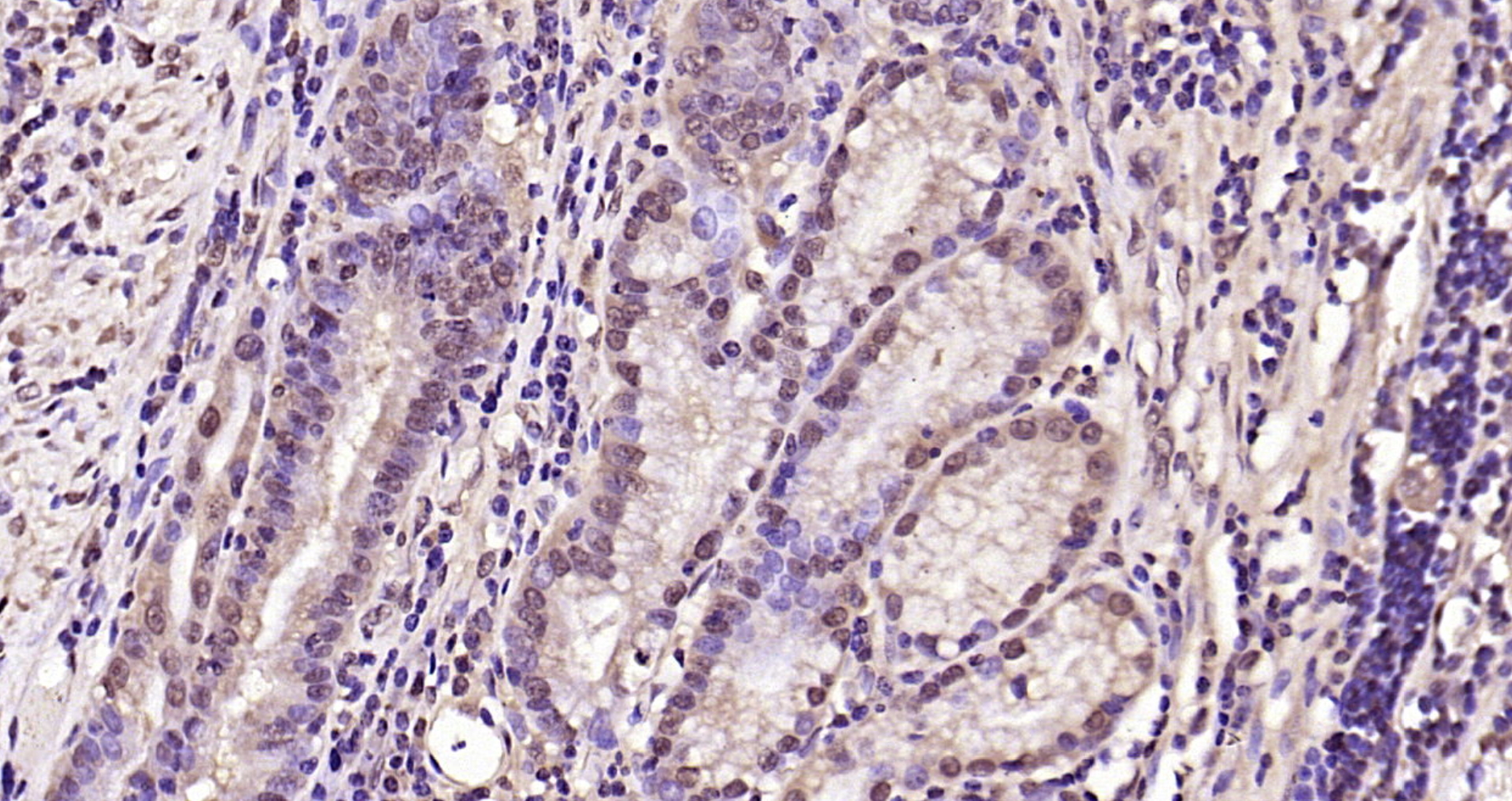 Paraformaldehyde-fixed, paraffin embedded Human gastric carcinoma; Antigen retrieval by boiling in sodium citrate buffer (pH6.0) for 15min; Block endogenous peroxidase by 3% hydrogen peroxide for 20 minutes; Blocking buffer (normal goat serum) at 37°C for 30min; Antibody incubation with CDK6 Polyclonal Antibody, Unconjugated (bs-0568R) at 1:200 overnight at 4°C, DAB staining.