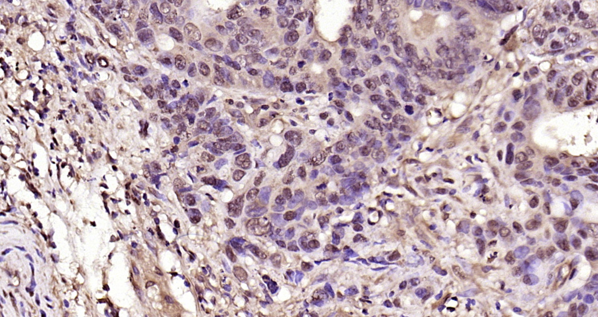 Paraformaldehyde-fixed, paraffin embedded Human rectal cancer; Antigen retrieval by boiling in sodium citrate buffer (pH6.0) for 15min; Block endogenous peroxidase by 3% hydrogen peroxide for 20 minutes; Blocking buffer (normal goat serum) at 37°C for 30min; Antibody incubation with CDK6 Polyclonal Antibody, Unconjugated (bs-0568R) at 1:200 overnight at 4°C, DAB staining.