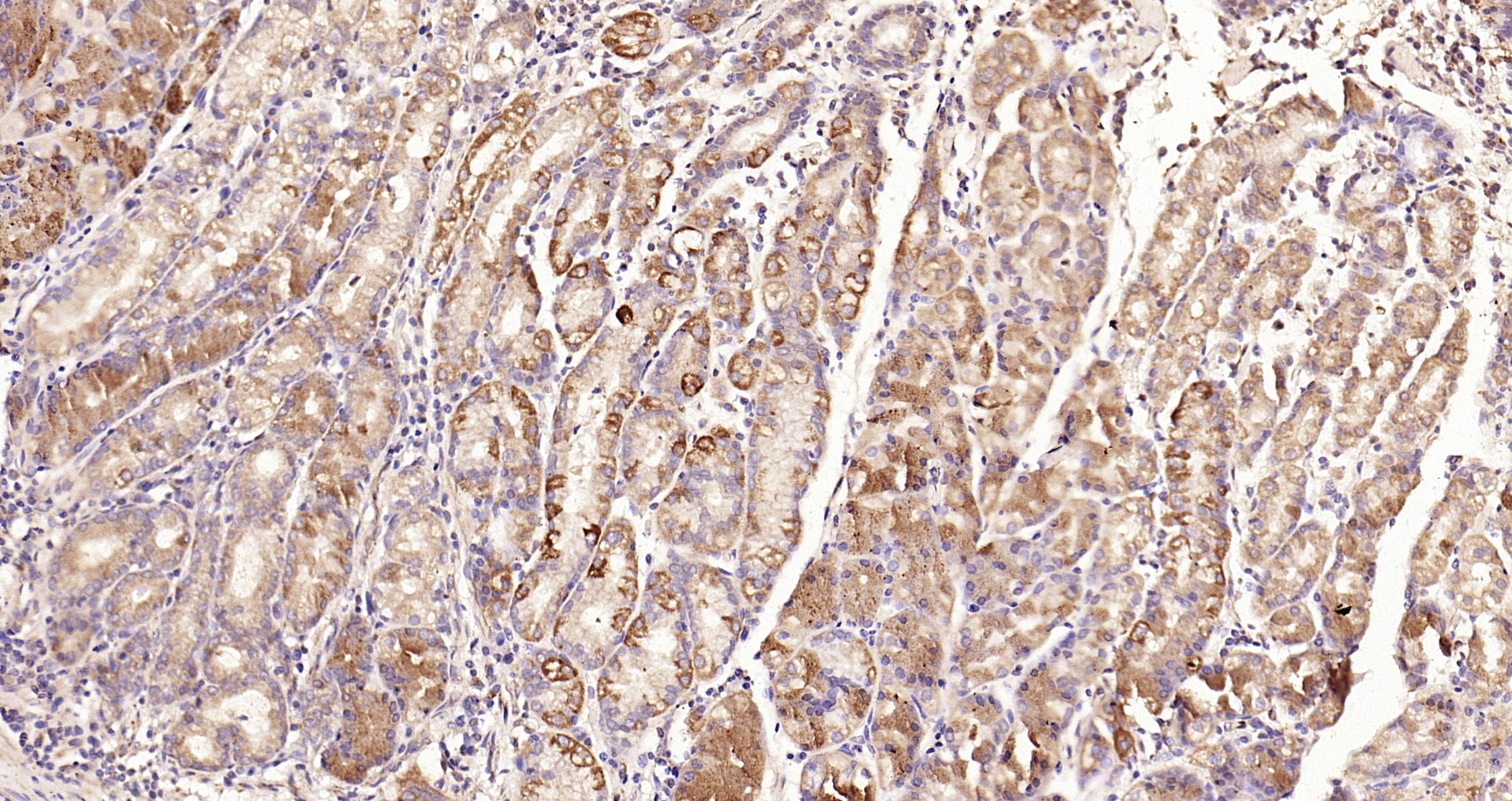 Paraformaldehyde-fixed, paraffin embedded Human gastric carcinoma; Antigen retrieval by boiling in sodium citrate buffer (pH6.0) for 15min; Block endogenous peroxidase by 3% hydrogen peroxide for 20 minutes; Blocking buffer (normal goat serum) at 37°C for 30min; Antibody incubation with TSSC3 Polyclonal Antibody, Unconjugated (bs-6884R) at 1:200 overnight at 4°C, DAB staining. Paraformaldehyde-fixed, paraffin embedded Human gastric carcinoma; Antigen retrieval by boiling in sodium citrate buffer (pH6.0) for 15min; Block endogenous peroxidase by 3% hydrogen peroxide for 20 minutes; Blocking buffer (normal goat serum) at 37°C for 30min; Antibody incubation with TSSC3 Polyclonal Antibody, Unconjugated (bs-6884R) at 1:200 overnight at 4°C, DAB staining.