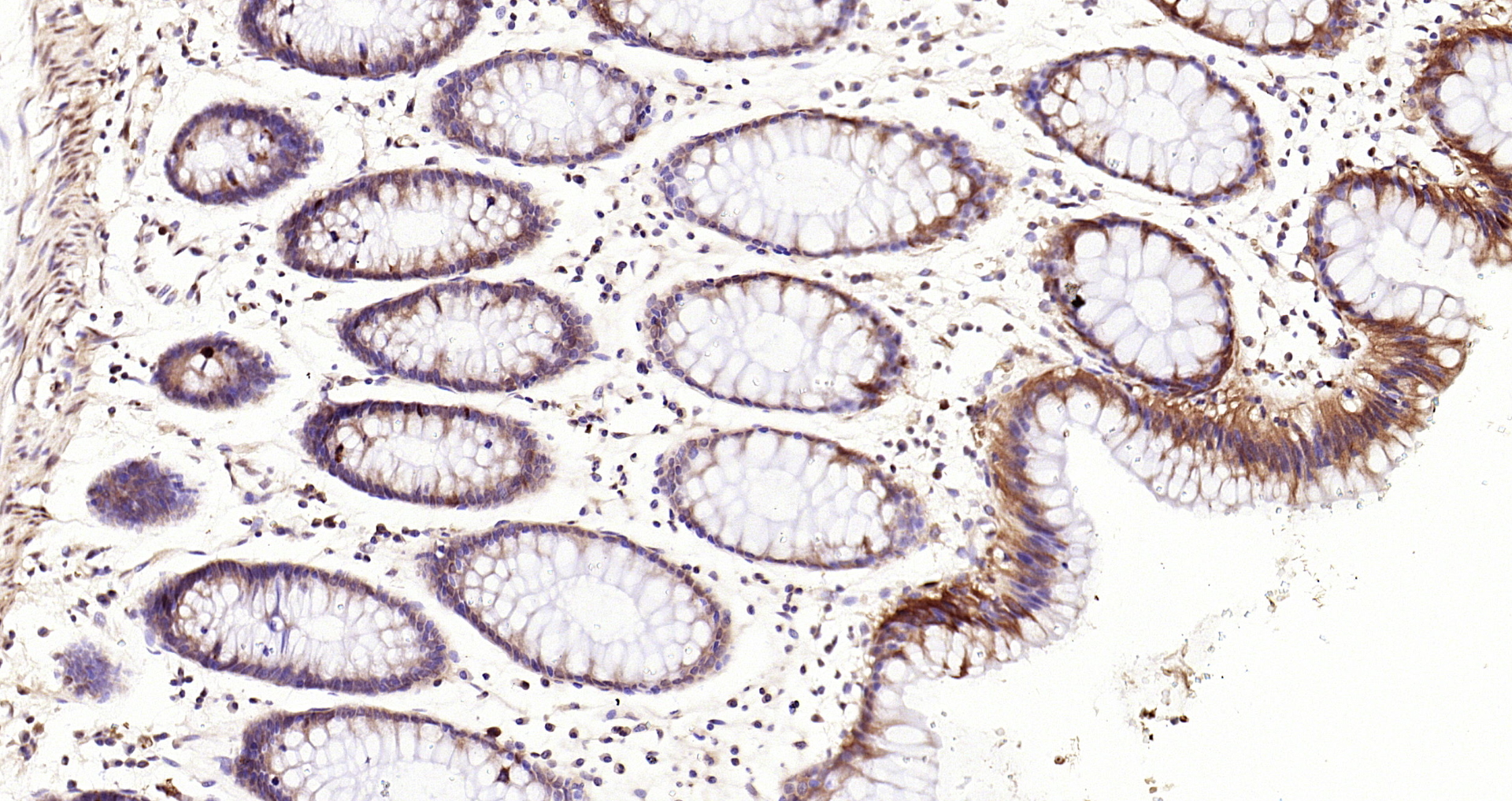 Paraformaldehyde-fixed, paraffin embedded Human colon; Antigen retrieval by boiling in sodium citrate buffer (pH6.0) for 15min; Block endogenous peroxidase by 3% hydrogen peroxide for 20 minutes; Blocking buffer (normal goat serum) at 37°C for 30min; Antibody incubation with RSK1(S380) (7A12) Monoclonal Antibody, Unconjugated (bsm-52199R) at 1:200 overnight at 4°C, DAB staining.