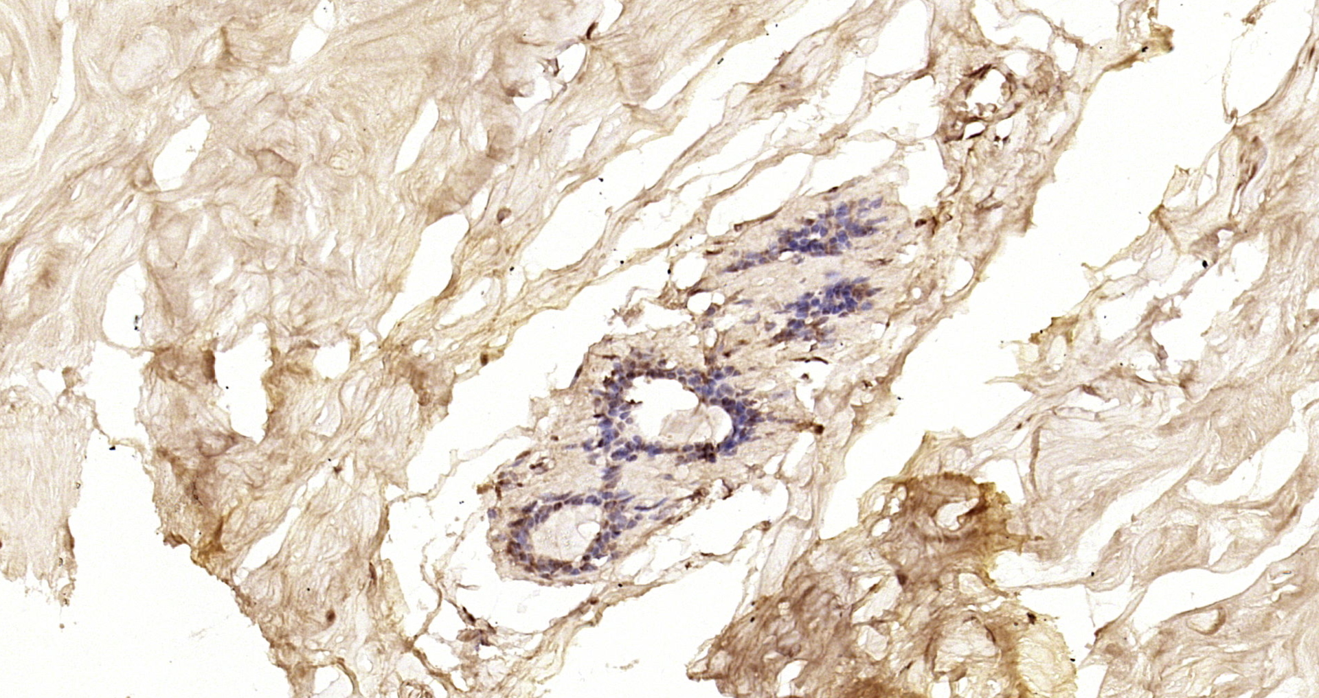 Paraformaldehyde-fixed, paraffin embedded Human breast cancer; Antigen retrieval by boiling in sodium citrate buffer (pH6.0) for 15min; Block endogenous peroxidase by 3% hydrogen peroxide for 20 minutes; Blocking buffer (normal goat serum) at 37°C for 30min; Antibody incubation with BRCA1 Polyclonal Antibody, Unconjugated (bs-0802R) at 1:200 overnight at 4°C, DAB staining.