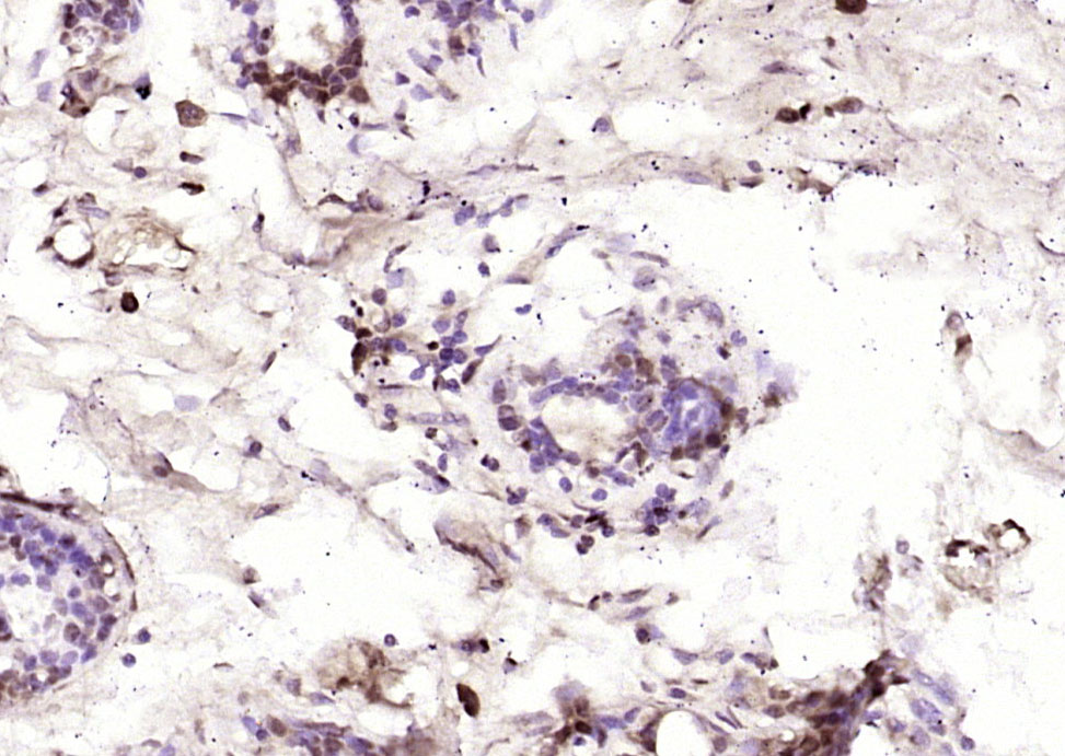 Paraformaldehyde-fixed, paraffin embedded Human breast cancer; Antigen retrieval by boiling in sodium citrate buffer (pH6.0) for 15min; Block endogenous peroxidase by 3% hydrogen peroxide for 20 minutes; Blocking buffer (normal goat serum) at 37°C for 30min; Antibody incubation with MEK1+MEK2(Ser222/Ser226) Polyclonal Antibody, Unconjugated (bs-5414R) at 1:200 overnight at 4°C, DAB staining.