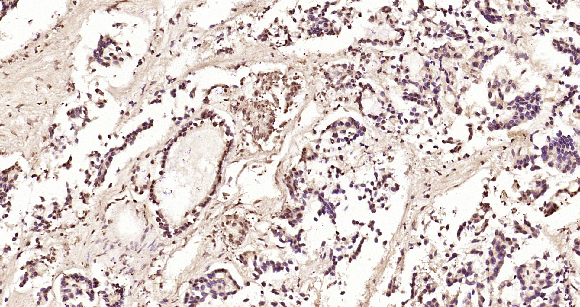 Paraformaldehyde-fixed, paraffin embedded Human gastric carcinoma; Antigen retrieval by boiling in sodium citrate buffer (pH6.0) for 15min; Block endogenous peroxidase by 3% hydrogen peroxide for 20 minutes; Blocking buffer (normal goat serum) at 37°C for 30min; Antibody incubation with RAD51(Thr309) Polyclonal Antibody, Unconjugated (bs-5677R) at 1:200 overnight at 4°C, DAB staining.