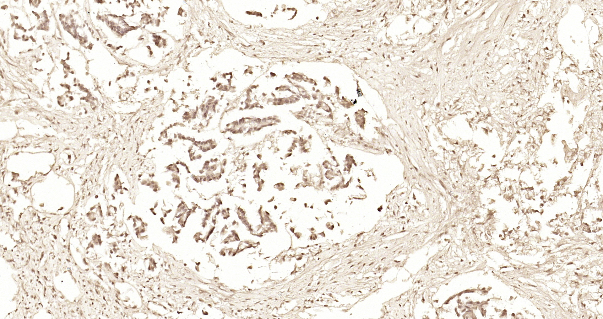 Paraformaldehyde-fixed, paraffin embedded Human gastric carcinoma; Antigen retrieval by boiling in sodium citrate buffer (pH6.0) for 15min; Block endogenous peroxidase by 3% hydrogen peroxide for 20 minutes; Blocking buffer (normal goat serum) at 37°C for 30min; Antibody incubation with C9orf86 Polyclonal Antibody, Unconjugated (bs-9545R) at 1:200 overnight at 4°C, DAB staining.