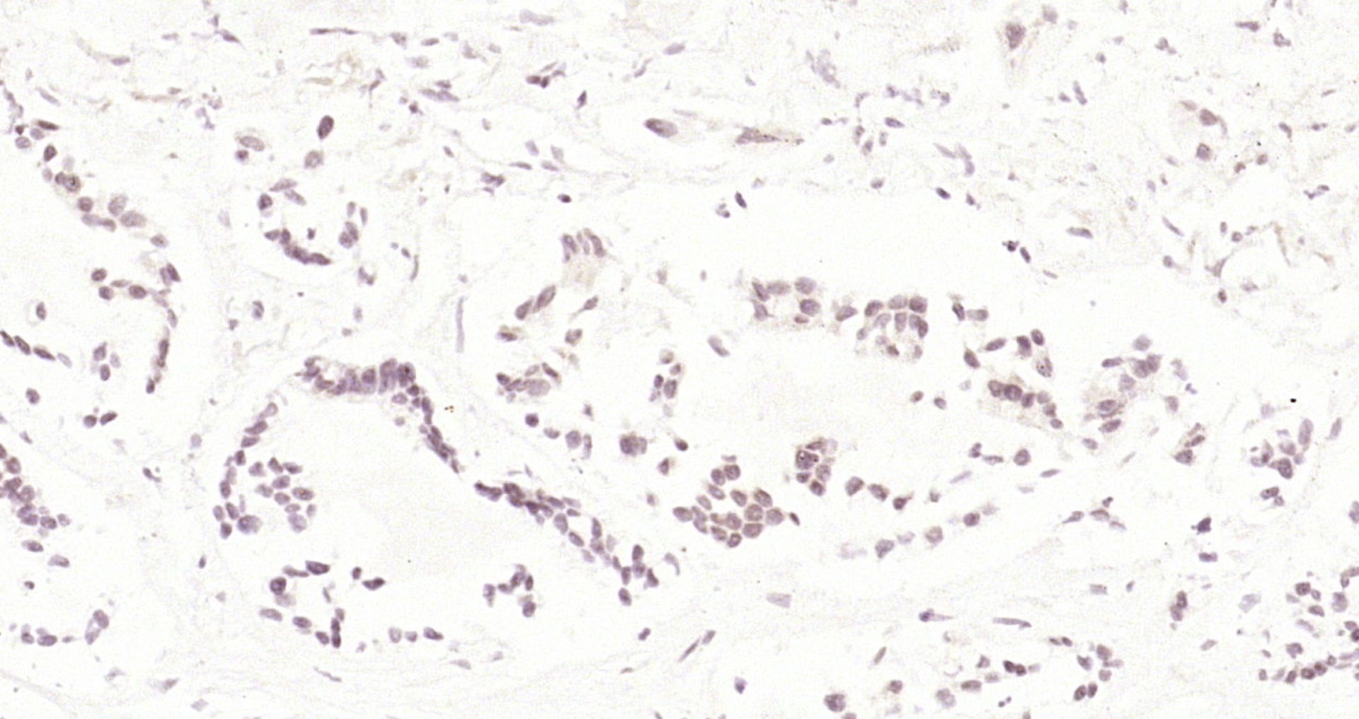 Paraformaldehyde-fixed, paraffin embedded Human gastric carcinoma; Antigen retrieval by boiling in sodium citrate buffer (pH6.0) for 15min; Block endogenous peroxidase by 3% hydrogen peroxide for 20 minutes; Blocking buffer (normal goat serum) at 37°C for 30min; Antibody incubation with CDK4 Polyclonal Antibody, Unconjugated (bs-0633R) at 1:200 overnight at 4°C, DAB staining.