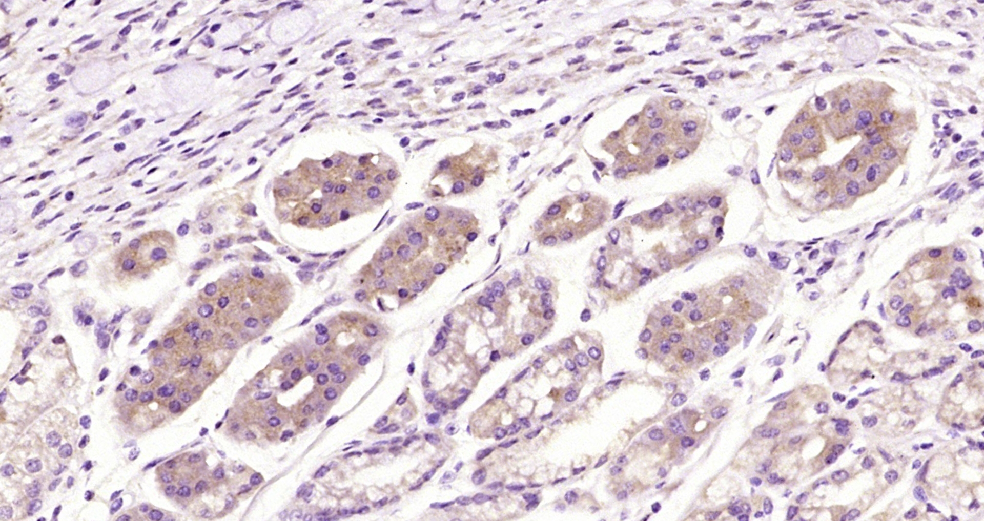 Paraformaldehyde-fixed, paraffin embedded Human gastric carcinoma; Antigen retrieval by boiling in sodium citrate buffer (pH6.0) for 15min; Block endogenous peroxidase by 3% hydrogen peroxide for 20 minutes; Blocking buffer (normal goat serum) at 37°C for 30min; Antibody incubation with proCNP Polyclonal Antibody, Unconjugated (bs-1069R) at 1:200 overnight at 4°C, DAB staining.