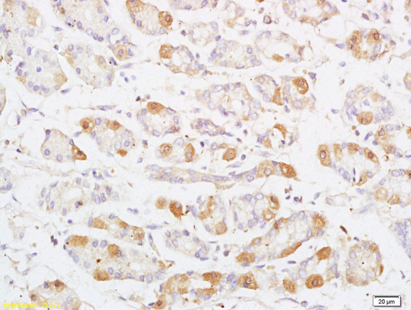 Formalin-fixed and paraffin embedded human colon carcinoma labeled with Anti Phospho-MAP3K8/Tpl2 (Thr290) Polyclonal Antibody, Unconjugated (bs-3455R) at 1:200 followed by conjugation to the secondary antibody and DAB staining