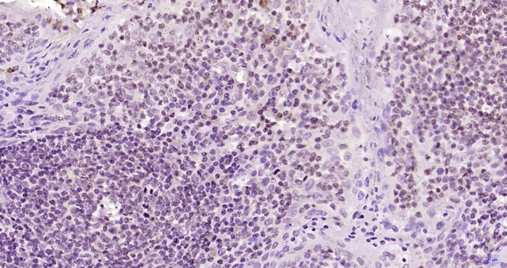 Paraformaldehyde-fixed, paraffin embedded Human tonsil; Antigen retrieval by boiling in sodium citrate buffer (pH6.0) for 15min; Block endogenous peroxidase by 3% hydrogen peroxide for 20 minutes; Blocking buffer (normal goat serum) at 37°C for 30min; Antibody incubation with DNAPK/PRKDC Polyclonal Antibody, Unconjugated (bs-1359R) at 1:200 overnight at 4°C, DAB staining.