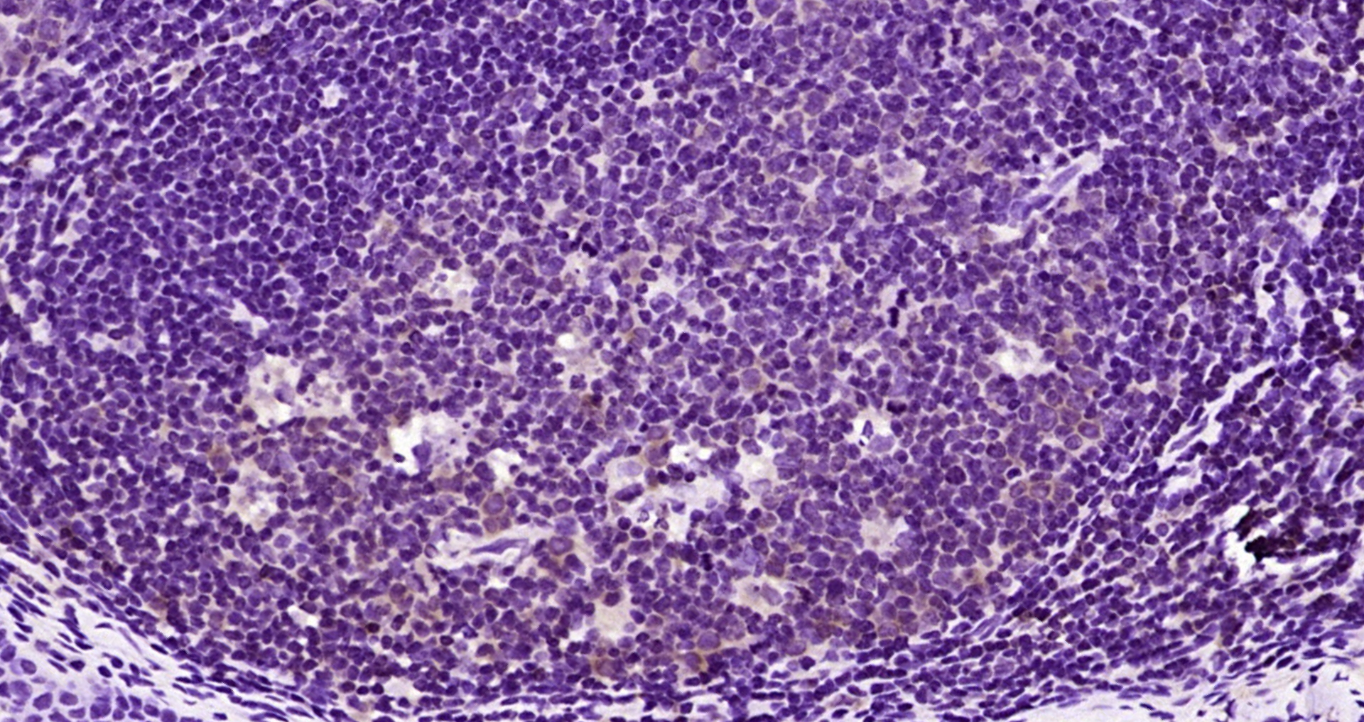 Paraformaldehyde-fixed, paraffin embedded Human tonsil; Antigen retrieval by boiling in sodium citrate buffer (pH6.0) for 15min; Block endogenous peroxidase by 3% hydrogen peroxide for 20 minutes; Blocking buffer (normal goat serum) at 37°C for 30min; Antibody incubation with IFI16/MNDA Polyclonal Antibody, Unconjugated (bs-1472R) at 1:200 overnight at 4°C, DAB staining.