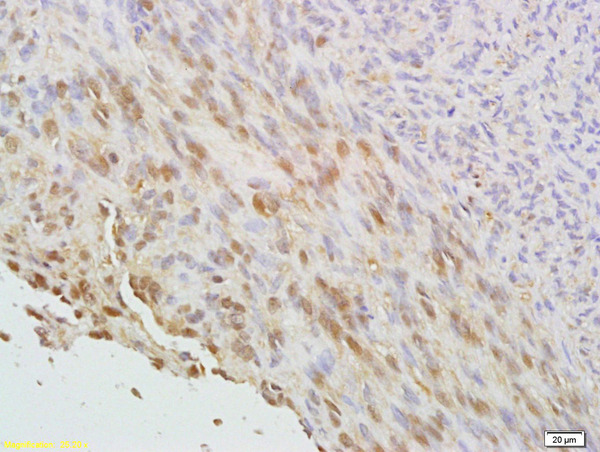 Formalin-fixed and paraffin embedded human cervical carcinoma labeled with Anti phospho-CDKN1A/P21 (Thr145) Polyclonal Antibody, Unconjugated (bs-5237R) at 1:200 followed by conjugation to the secondary antibody and DAB staining