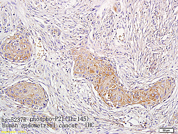 Formalin-fixed and paraffin embedded human endometrial cancer labeled with Anti-phospho-CDKN1A/P21 (Thr145) Polyclonal Antibody, Unconjugated (bs-5237R) followed by conjugation to the secondary antibody and DAB staining