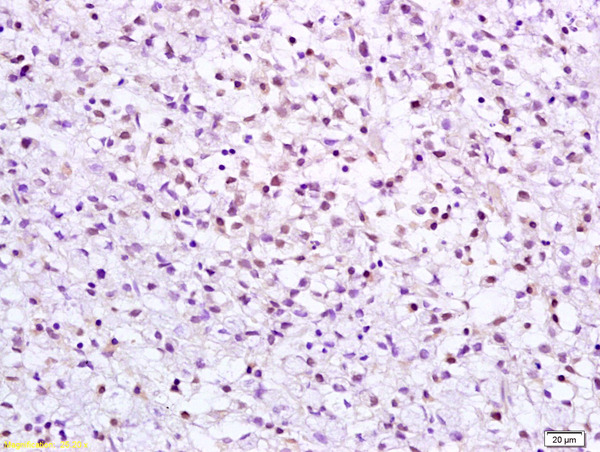 Formalin-fixed and paraffin embedded human gastric carcinoma labeled with Anti CHK2 Polyclonal Antibody, Unconjugated (bs-1391R) at 1:200 followed by conjugation to the secondary antibody and DAB staining