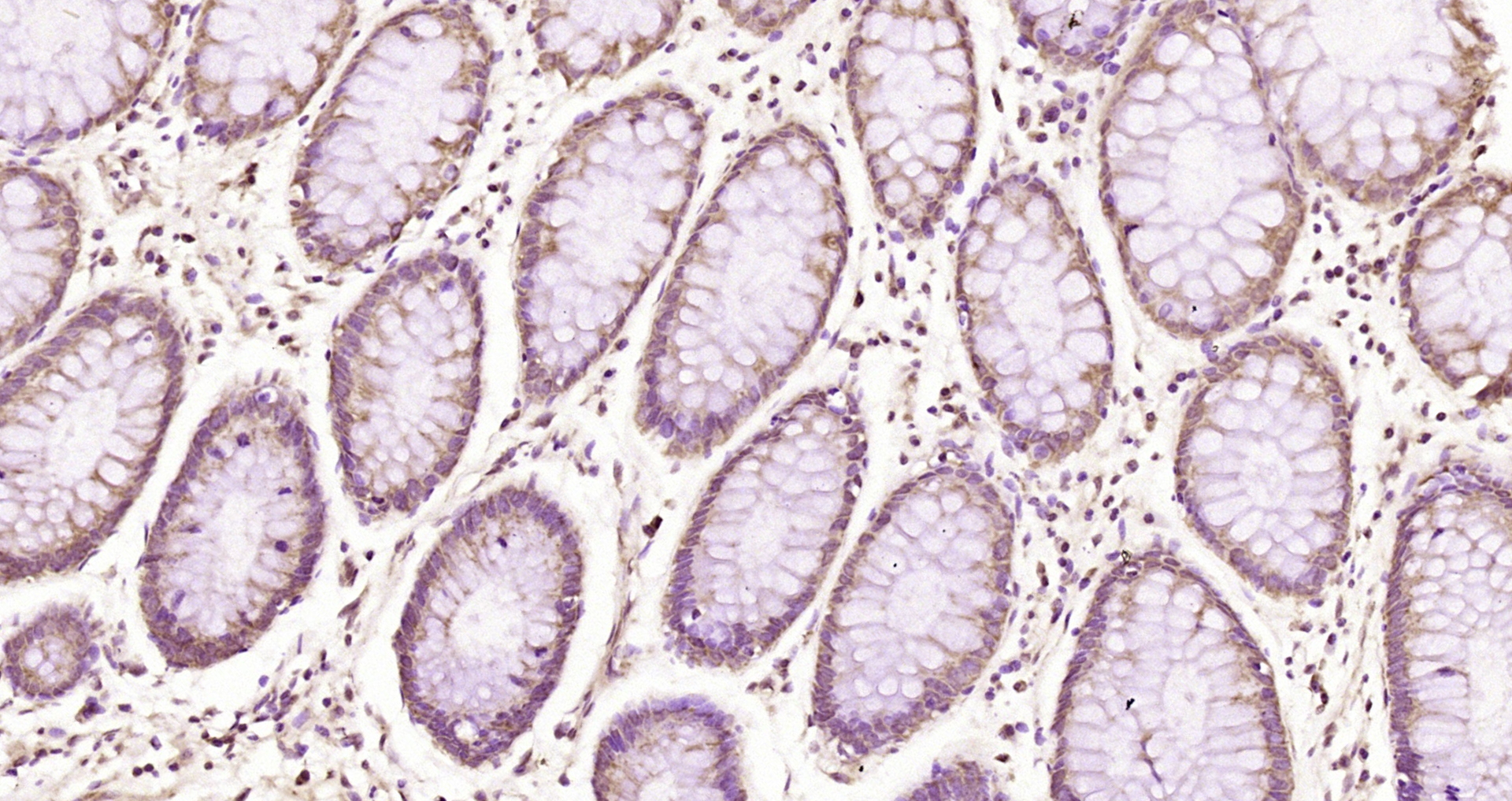 Paraformaldehyde-fixed, paraffin embedded Human colon cancer; Antigen retrieval by boiling in sodium citrate buffer (pH6.0) for 15min; Block endogenous peroxidase by 3% hydrogen peroxide for 20 minutes; Blocking buffer (normal goat serum) at 37°C for 30min; Antibody incubation with ATF2 (Thr69/71) Polyclonal Antibody, Unconjugated (bs-3033R) at 1:200 overnight at 4°C, DAB staining.