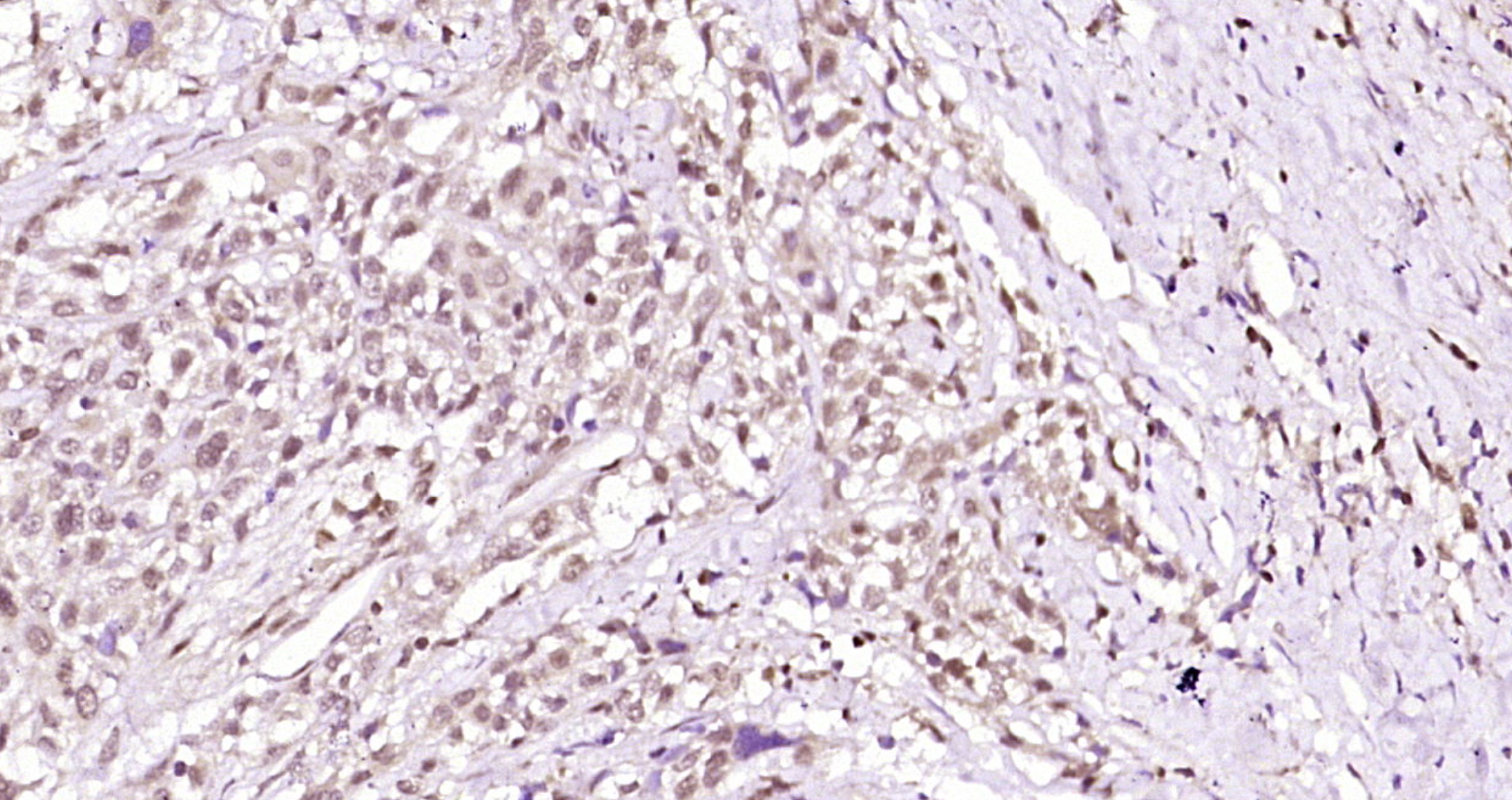 Paraformaldehyde-fixed, paraffin embedded Human colon cancer; Antigen retrieval by boiling in sodium citrate buffer (pH6.0) for 15min; Block endogenous peroxidase by 3% hydrogen peroxide for 20 minutes; Blocking buffer (normal goat serum) at 37°C for 30min; Antibody incubation with PRKACB(Thr198) Polyclonal Antibody, Unconjugated (bs-3725R) at 1:200 overnight at 4°C, DAB staining. Paraformaldehyde-fixed, paraffin embedded Human colon cancer; Antigen retrieval by boiling in sodium citrate buffer (pH6.0) for 15min; Block endogenous peroxidase by 3% hydrogen peroxide for 20 minutes; Blocking buffer (normal goat serum) at 37°C for 30min; Antibody incubation with PRKACB(Thr198) Polyclonal Antibody, Unconjugated (bs-3725R) at 1:200 overnight at 4°C, DAB staining.
