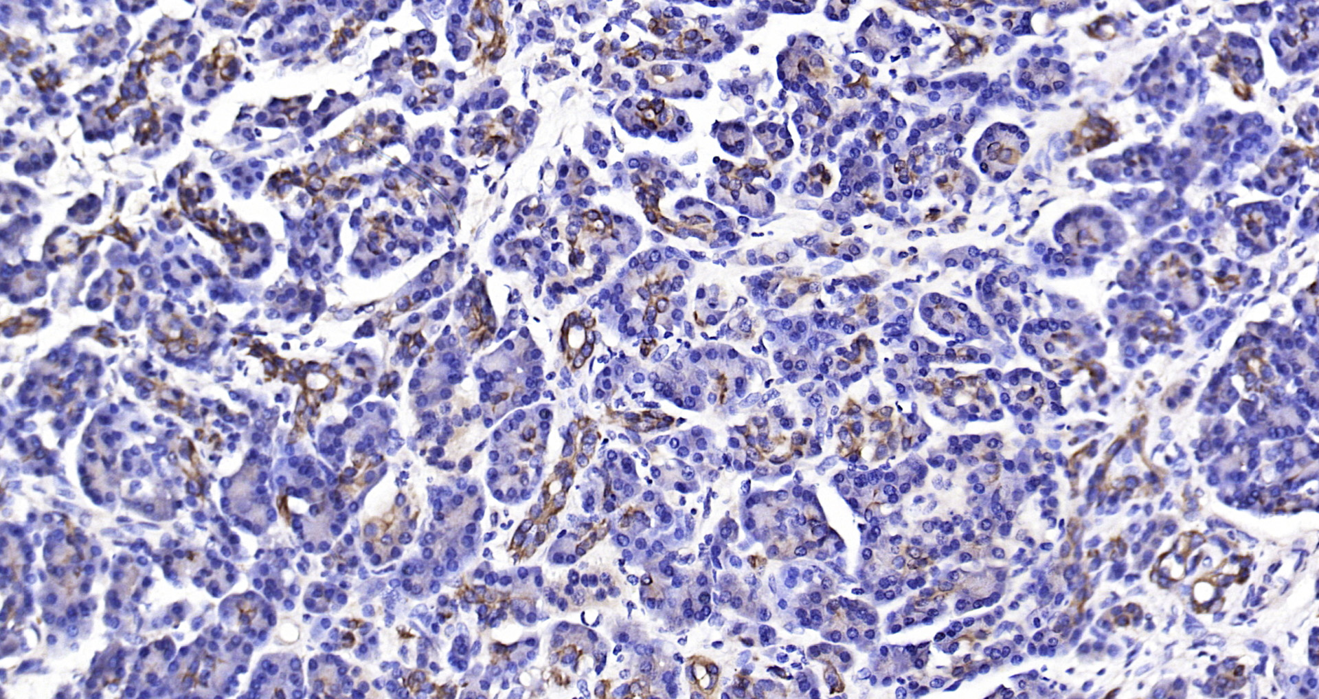 Paraformaldehyde-fixed, paraffin embedded Human pancreatic cancer; Antigen retrieval by boiling in sodium citrate buffer (pH6.0) for 15min; Block endogenous peroxidase by 3% hydrogen peroxide for 20 minutes; Blocking buffer (normal goat serum) at 37°C for 30min; Antibody incubation with CK18 Polyclonal Antibody, Unconjugated (bs-1339R) at 1:200 overnight at 4°C, DAB staining.