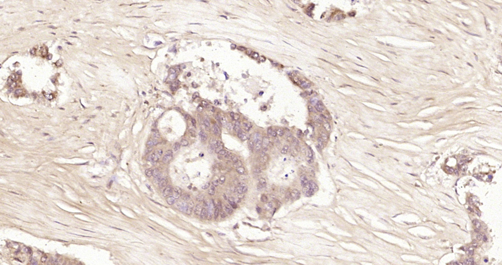 Paraformaldehyde-fixed, paraffin embedded Human cervical cancer; Antigen retrieval by boiling in sodium citrate buffer (pH6.0) for 15min; Block endogenous peroxidase by 3% hydrogen peroxide for 20 minutes; Blocking buffer (normal goat serum) at 37°C for 30min; Antibody incubation with Selenium Binding Protein 1 Polyclonal Antibody, Unconjugated (bs-4200R) at 1:200 overnight at 4°C, DAB staining. Paraformaldehyde-fixed, paraffin embedded Human cervical cancer; Antigen retrieval by boiling in sodium citrate buffer (pH6.0) for 15min; Block endogenous peroxidase by 3% hydrogen peroxide for 20 minutes; Blocking buffer (normal goat serum) at 37°C for 30min; Antibody incubation with Selenium Binding Protein 1 Polyclonal Antibody, Unconjugated (bs-4200R) at 1:200 overnight at 4°C, DAB staining.