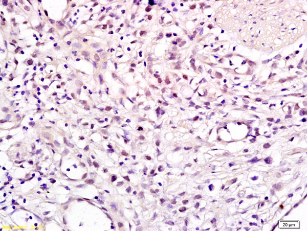 Formalin-fixed and paraffin embedded human gastric carcinoma labeled with Anti CHMP1A Polyclonal Antibody, Unconjugated (bs-4207R) at 1:200 followed by conjugation to the secondary antibody and DAB staining