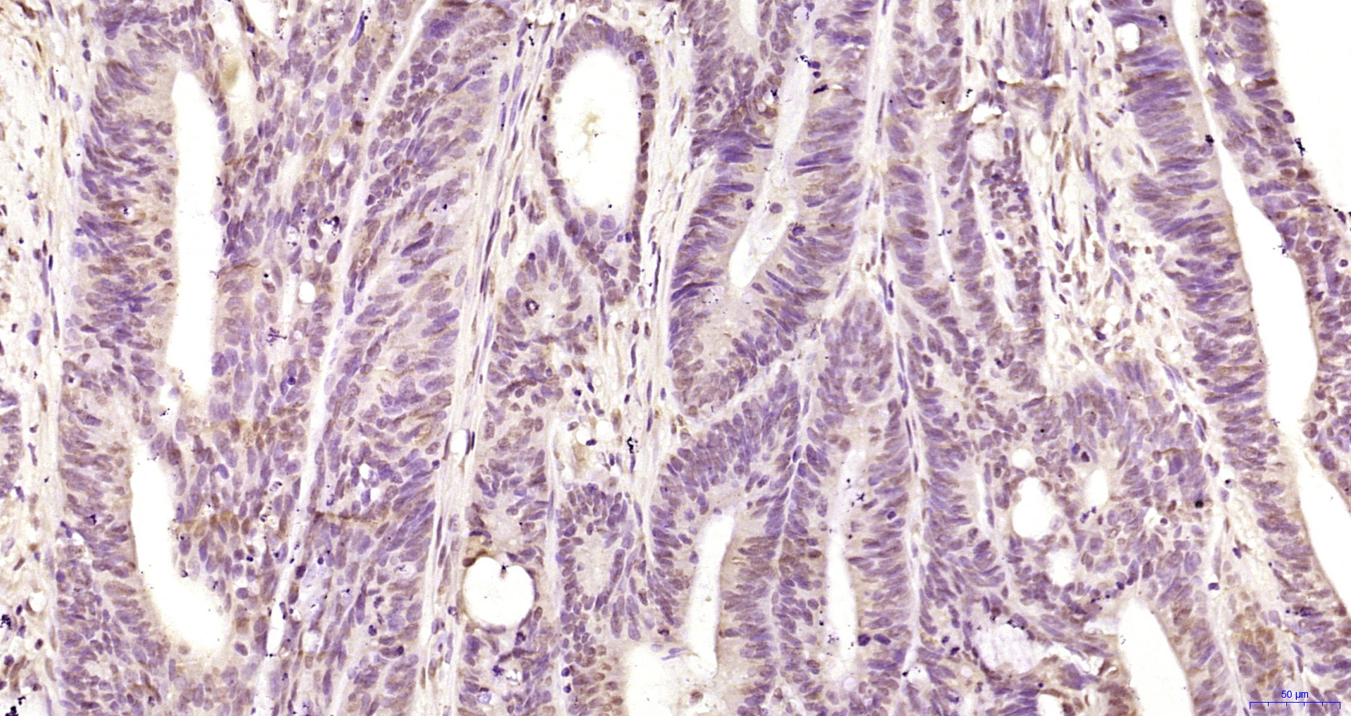 Paraformaldehyde-fixed, paraffin embedded Human colon cancer; Antigen retrieval by boiling in sodium citrate buffer (pH6.0) for 15min; Block endogenous peroxidase by 3% hydrogen peroxide for 20 minutes; Blocking buffer (normal goat serum) at 37°C for 30min; Antibody incubation with hnRNP K Polyclonal Antibody, Unconjugated (bs-4296R) at 1:200 overnight at 4°C, DAB staining.