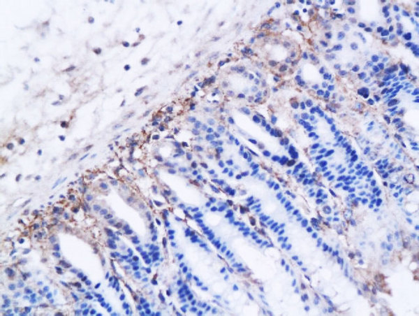 Formalin-fixed and paraffin embedded ovarian cancer xenograft labeled with Anti-DBC2 receptor Polyclonal Antibody, Unconjugated (bs-4274R) followed by conjugation to the secondary antibody and DAB staining