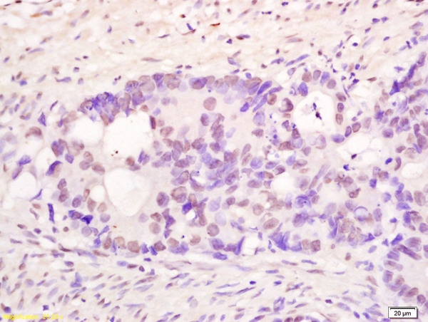 Formalin-fixed and paraffin embedded human colon carcinoma labeled with Anti PMS1 Polyclonal Antibody, Unconjugated (bs-4965R) at 1:200 followed by conjugation to the secondary antibody and DAB staining