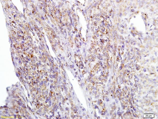 Formalin-fixed and paraffin embedded human cervical carcinoma labeled with Anti APE/Girdin Polyclonal Antibody, Unconjugated (bs-5150R) at 1:200 followed by conjugation to the secondary antibody and DAB staining