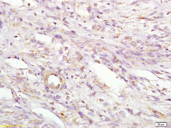 Formalin-fixed and paraffin embedded human cervical carcinoma labeled with Anti MIIP Polyclonal Antibody, Unconjugated (bs-5842R) at 1:200 followed by conjugation to the secondary antibody and DAB staining