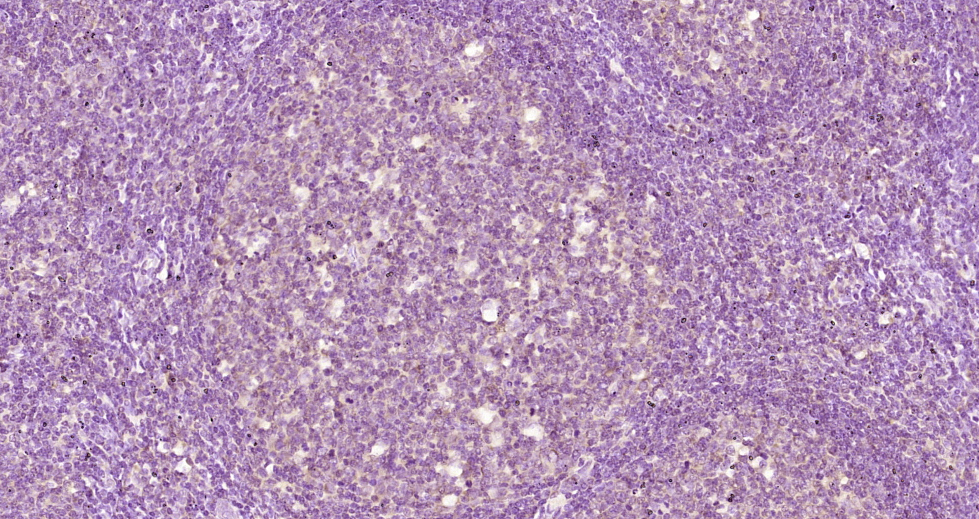 Paraformaldehyde-fixed, paraffin embedded Human tonsil; Antigen retrieval by boiling in sodium citrate buffer (pH6.0) for 15min; Block endogenous peroxidase by 3% hydrogen peroxide for 20 minutes; Blocking buffer (normal goat serum) at 37°C for 30min; Antibody incubation with CDCA7L Polyclonal Antibody, Unconjugated (bs-5963R) at 1:200 overnight at 4°C, DAB staining.