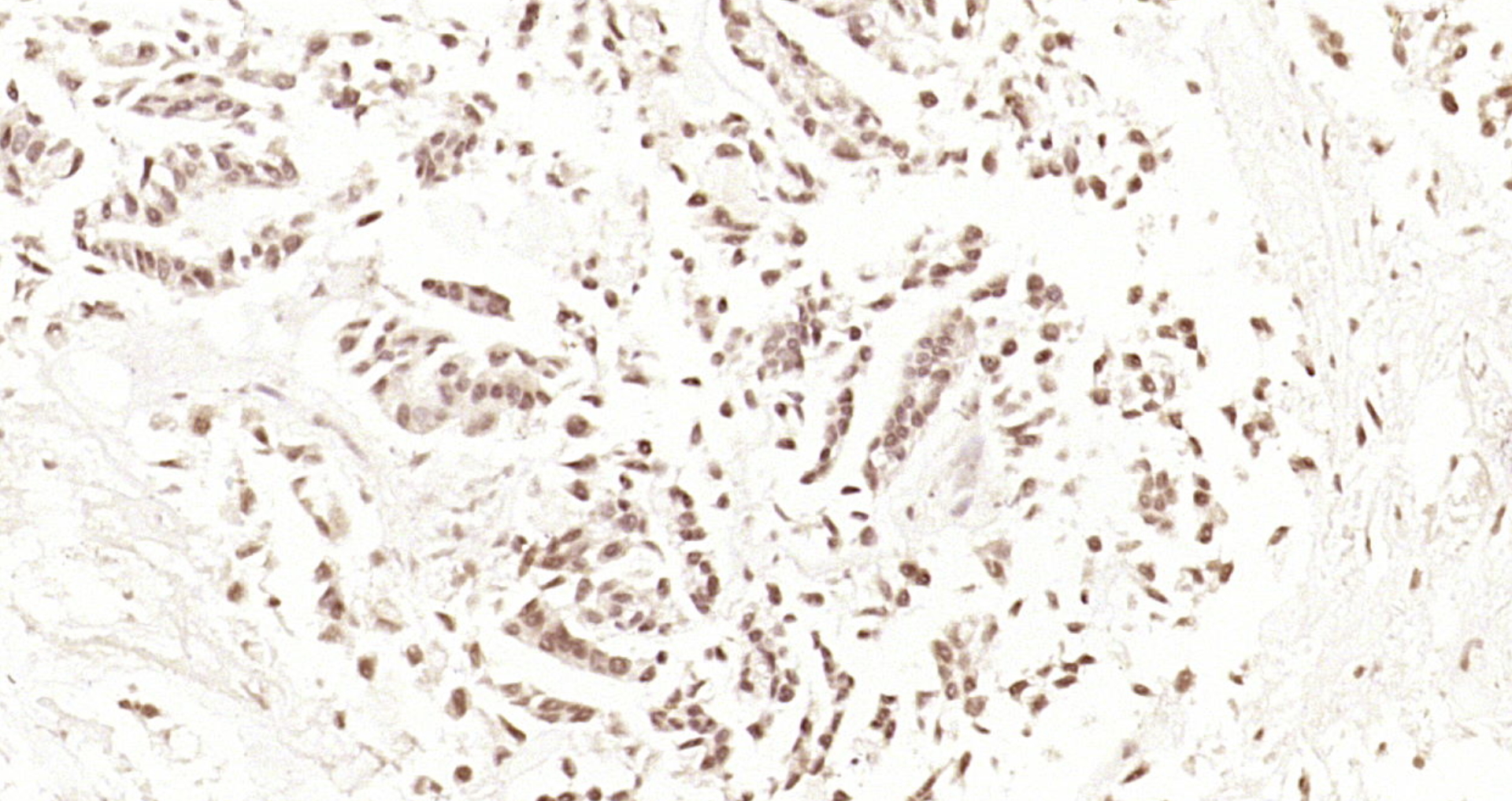 Paraformaldehyde-fixed, paraffin embedded Human gastric carcinoma; Antigen retrieval by boiling in sodium citrate buffer (pH6.0) for 15min; Block endogenous peroxidase by 3% hydrogen peroxide for 20 minutes; Blocking buffer (normal goat serum) at 37°C for 30min; Antibody incubation with RSRC2 Polyclonal Antibody, Unconjugated (bs-6097R) at 1:200 overnight at 4°C, DAB staining.