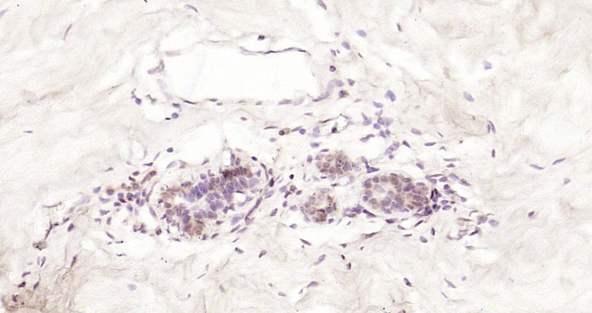 Paraformaldehyde-fixed, paraffin embedded Human breast cancer; Antigen retrieval by boiling in sodium citrate buffer (pH6.0) for 15min; Block endogenous peroxidase by 3% hydrogen peroxide for 20 minutes; Blocking buffer (normal goat serum) at 37°C for 30min; Antibody incubation with MDM2BP Polyclonal Antibody, Unconjugated (bs-6388R) at 1:200 overnight at 4°C, DAB staining.