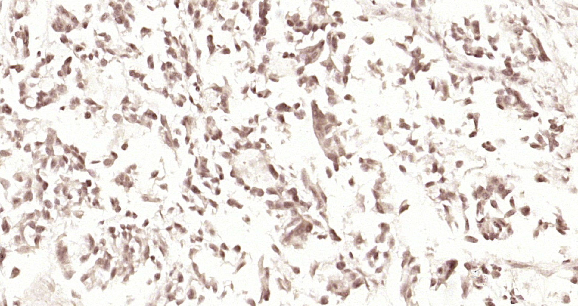Paraformaldehyde-fixed, paraffin embedded Human gastric carcinoma; Antigen retrieval by boiling in sodium citrate buffer (pH6.0) for 15min; Block endogenous peroxidase by 3% hydrogen peroxide for 20 minutes; Blocking buffer (normal goat serum) at 37°C for 30min; Antibody incubation with RPL5 Polyclonal Antibody, Unconjugated (bs-6573R) at 1:200 overnight at 4°C, DAB staining.