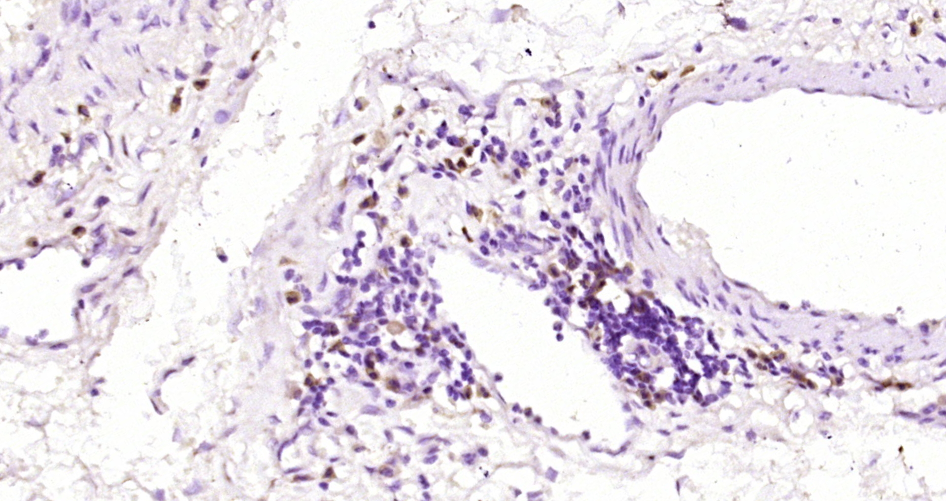 Paraformaldehyde-fixed, paraffin embedded Human esophageal carcinoma; Antigen retrieval by boiling in sodium citrate buffer (pH6.0) for 15min; Block endogenous peroxidase by 3% hydrogen peroxide for 20 minutes; Blocking buffer (normal goat serum) at 37°C for 30min; Antibody incubation with MAGEA12 Polyclonal Antibody, Unconjugated (bs-6818R) at 1:200 overnight at 4°C, DAB staining.
