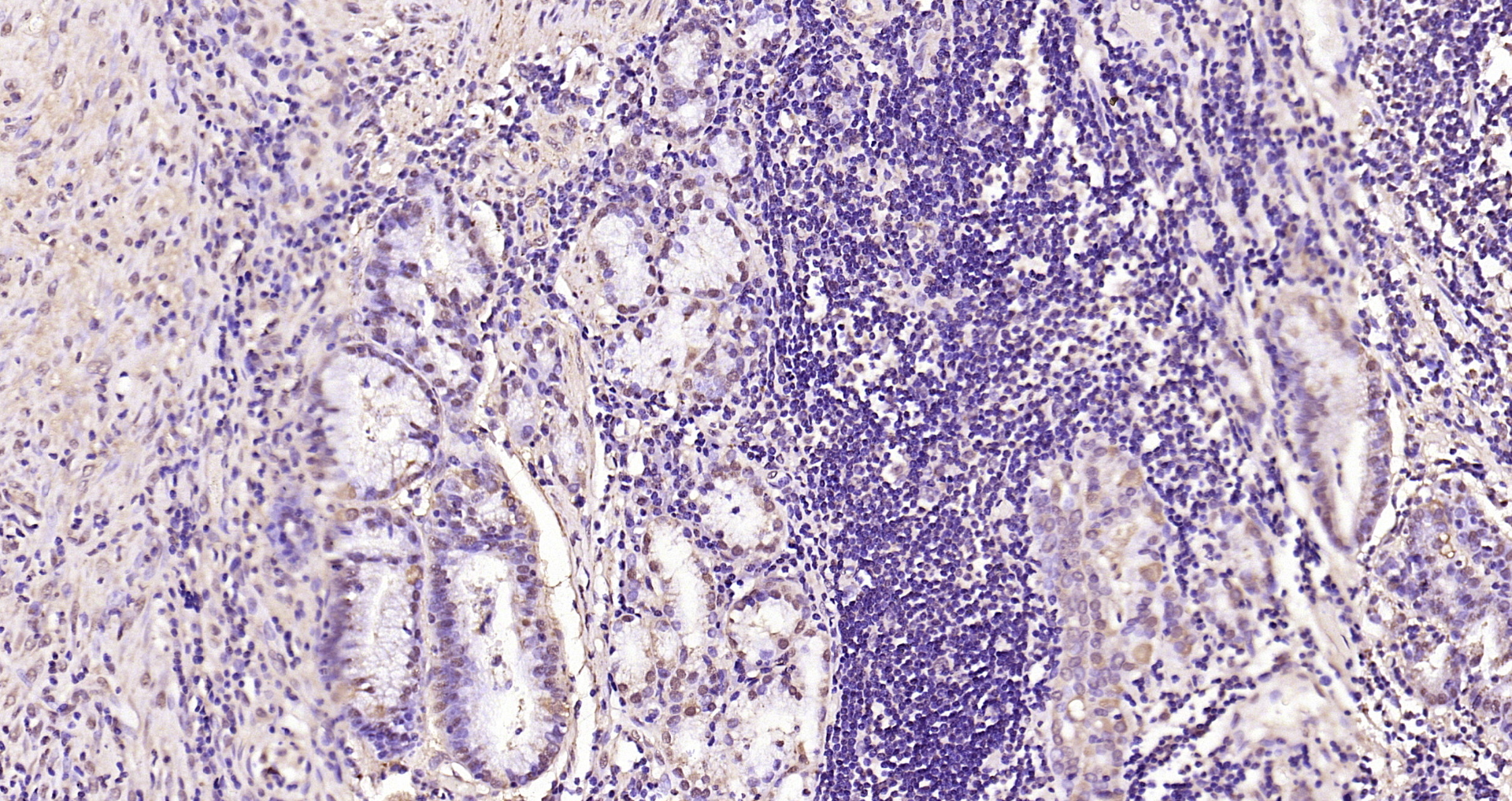 Paraformaldehyde-fixed, paraffin embedded Human gastric carcinoma; Antigen retrieval by boiling in sodium citrate buffer (pH6.0) for 15min; Block endogenous peroxidase by 3% hydrogen peroxide for 20 minutes; Blocking buffer (normal goat serum) at 37°C for 30min; Antibody incubation with Smad3 (Ser423 + Ser425) Polyclonal Antibody, Unconjugated (bs-3425R) at 1:200 overnight at 4°C, DAB staining.