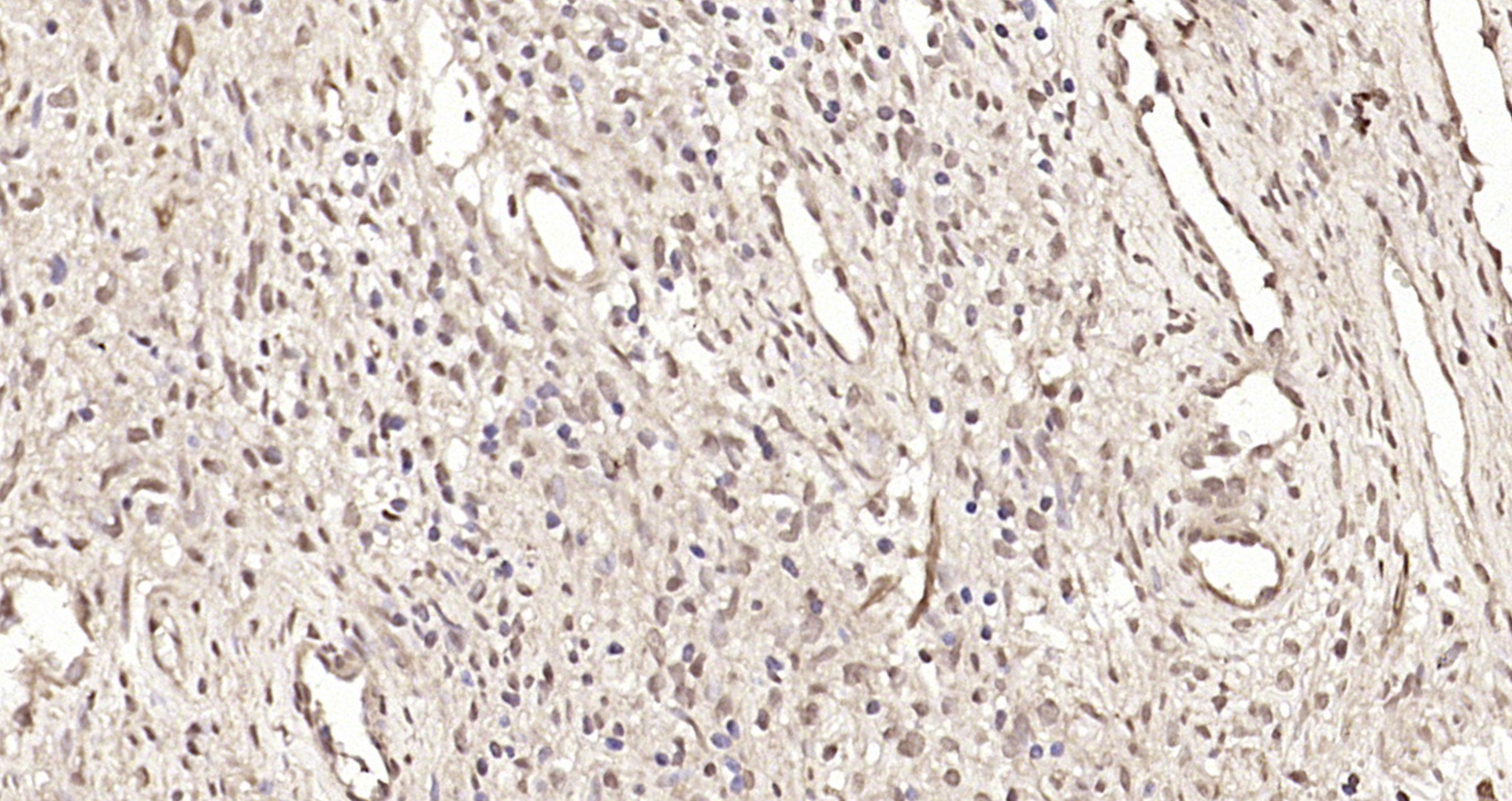 Paraformaldehyde-fixed, paraffin embedded Human prostate; Antigen retrieval by boiling in sodium citrate buffer (pH6.0) for 15min; Block endogenous peroxidase by 3% hydrogen peroxide for 20 minutes; Blocking buffer (normal goat serum) at 37°C for 30min; Antibody incubation with SMC5 Polyclonal Antibody, Unconjugated (bs-7729R) at 1:200 overnight at 4°C, DAB staining. Paraformaldehyde-fixed, paraffin embedded Human prostate; Antigen retrieval by boiling in sodium citrate buffer (pH6.0) for 15min; Block endogenous peroxidase by 3% hydrogen peroxide for 20 minutes; Blocking buffer (normal goat serum) at 37°C for 30min; Antibody incubation with SMC5 Polyclonal Antibody, Unconjugated (bs-7729R) at 1:200 overnight at 4°C, DAB staining.