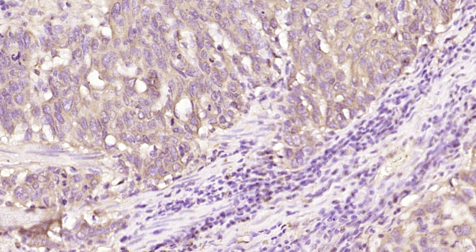 Paraformaldehyde-fixed, paraffin embedded Human esophageal carcinoma; Antigen retrieval by boiling in sodium citrate buffer (pH6.0) for 15min; Block endogenous peroxidase by 3% hydrogen peroxide for 20 minutes; Blocking buffer (normal goat serum) at 37°C for 30min; Antibody incubation with ODZ3 Polyclonal Antibody, Unconjugated (bs-9061R) at 1:200 overnight at 4°C, DAB staining.