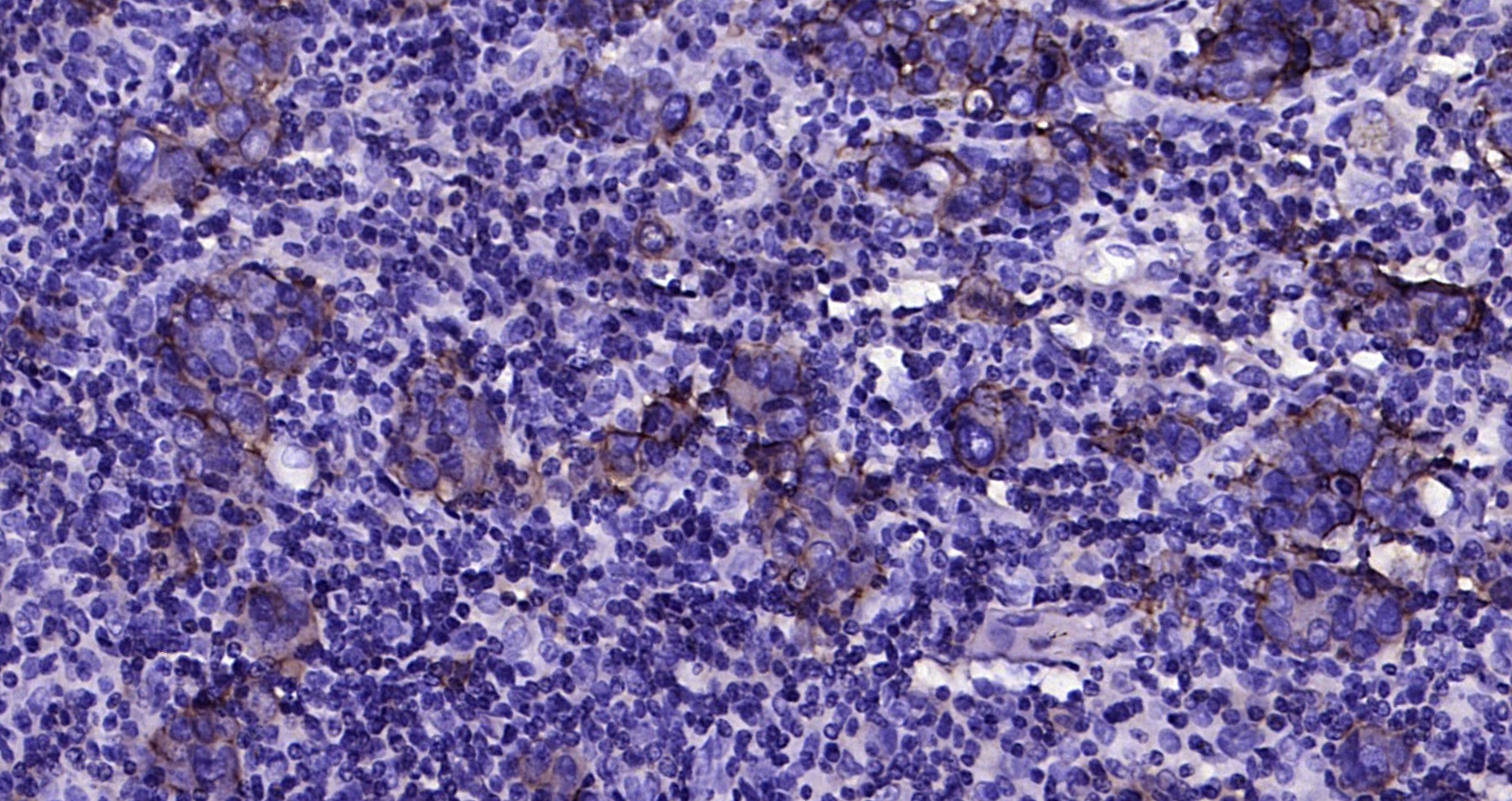 Paraformaldehyde-fixed, paraffin embedded Human gastric carcinoma; Antigen retrieval by boiling in sodium citrate buffer (pH6.0) for 15min; Block endogenous peroxidase by 3% hydrogen peroxide for 20 minutes; Blocking buffer (normal goat serum) at 37°C for 30min; Antibody incubation with CD46 (4C3) Monoclonal Antibody, Unconjugated (bsm-54335R) at 1:200 overnight at 4°C, DAB staining.
