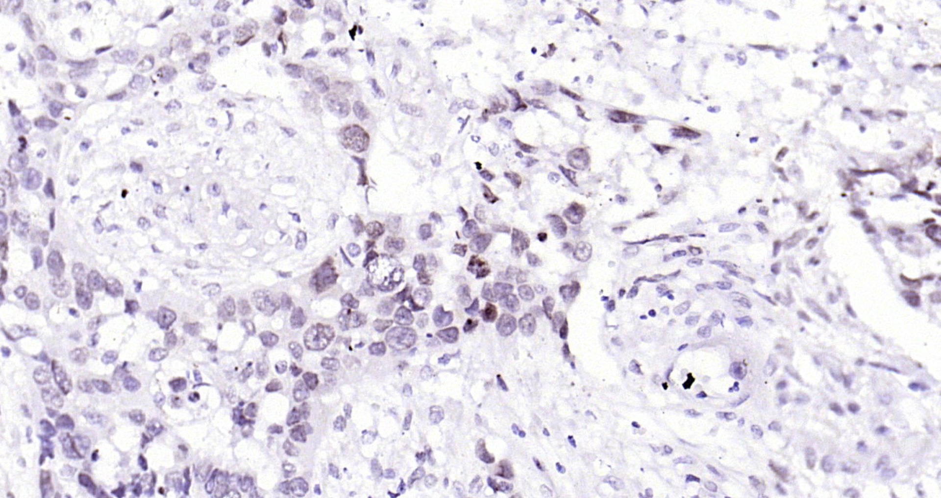 Paraformaldehyde-fixed, paraffin embedded Human esophageal carcinoma; Antigen retrieval by boiling in sodium citrate buffer (pH6.0) for 15min; Block endogenous peroxidase by 3% hydrogen peroxide for 20 minutes; Blocking buffer (normal goat serum) at 37°C for 30min; Antibody incubation with BANF1 (11H3) Monoclonal Antibody, Unconjugated (bsm-54435R) at 1:200 overnight at 4°C, DAB staining. Paraformaldehyde-fixed, paraffin embedded Human esophageal carcinoma; Antigen retrieval by boiling in sodium citrate buffer (pH6.0) for 15min; Block endogenous peroxidase by 3% hydrogen peroxide for 20 minutes; Blocking buffer (normal goat serum) at 37°C for 30min; Antibody incubation with BANF1 (11H3) Monoclonal Antibody, Unconjugated (bsm-54435R) at 1:200 overnight at 4°C, DAB staining.