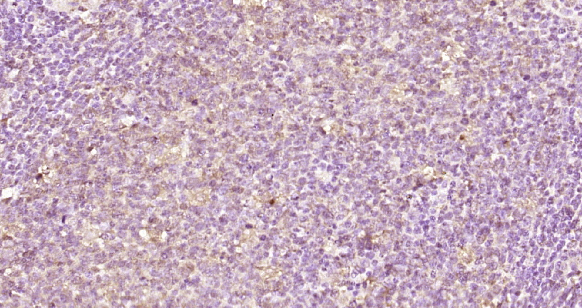 Paraformaldehyde-fixed, paraffin embedded Human tonsil; Antigen retrieval by boiling in sodium citrate buffer (pH6.0) for 15min; Block endogenous peroxidase by 3% hydrogen peroxide for 20 minutes; Blocking buffer (normal goat serum) at 37°C for 30min; Antibody incubation with FAM76A Polyclonal Antibody, Unconjugated (bs-9658R) at 1:200 overnight at 4°C, DAB staining. Paraformaldehyde-fixed, paraffin embedded Human tonsil; Antigen retrieval by boiling in sodium citrate buffer (pH6.0) for 15min; Block endogenous peroxidase by 3% hydrogen peroxide for 20 minutes; Blocking buffer (normal goat serum) at 37°C for 30min; Antibody incubation with FAM76A Polyclonal Antibody, Unconjugated (bs-9658R) at 1:200 overnight at 4°C, DAB staining.