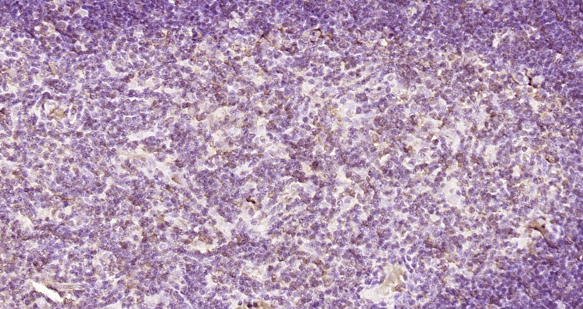 Paraformaldehyde-fixed, paraffin embedded Rat thymus; Antigen retrieval by boiling in sodium citrate buffer (pH6.0) for 15min; Block endogenous peroxidase by 3% hydrogen peroxide for 20 minutes; Blocking buffer (normal goat serum) at 37°C for 30min; Antibody incubation with FAM76A Polyclonal Antibody, Unconjugated (bs-9658R) at 1:200 overnight at 4°C, DAB staining. Paraformaldehyde-fixed, paraffin embedded Rat thymus; Antigen retrieval by boiling in sodium citrate buffer (pH6.0) for 15min; Block endogenous peroxidase by 3% hydrogen peroxide for 20 minutes; Blocking buffer (normal goat serum) at 37°C for 30min; Antibody incubation with FAM76A Polyclonal Antibody, Unconjugated (bs-9658R) at 1:200 overnight at 4°C, DAB staining.