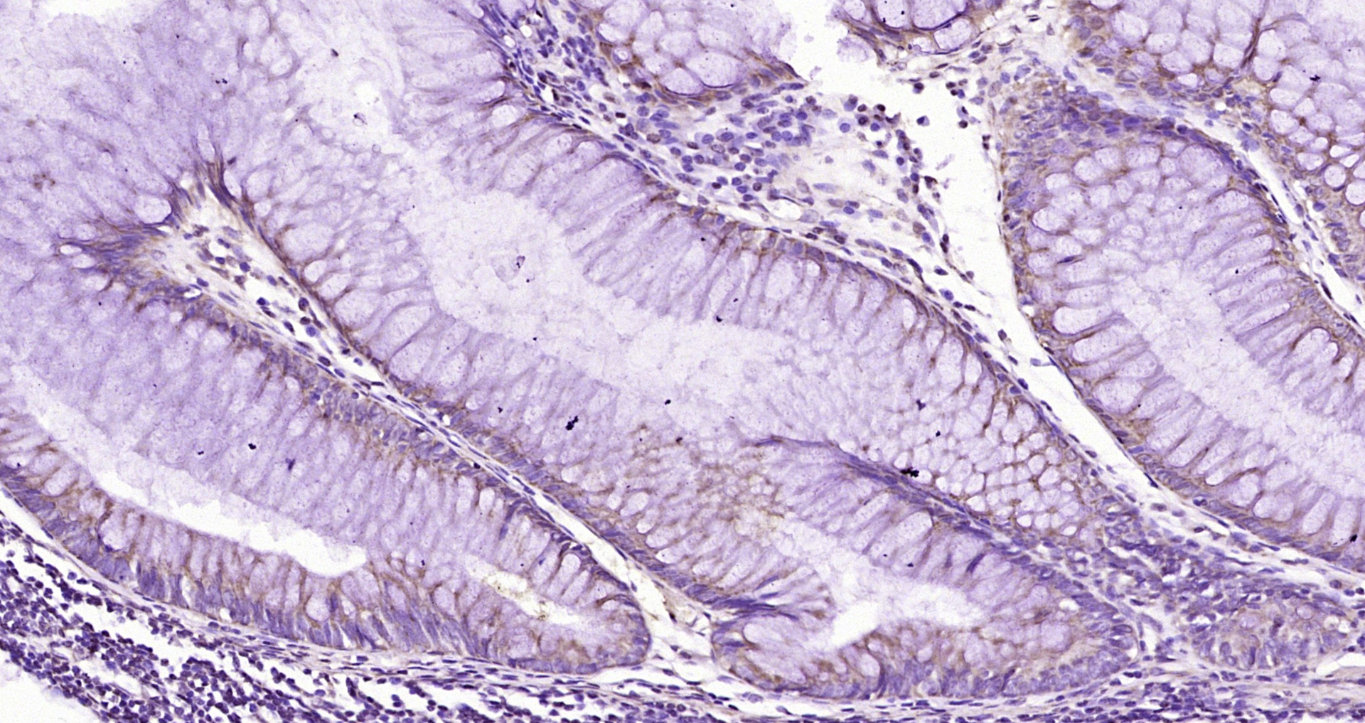 Paraformaldehyde-fixed, paraffin embedded Human colon cancer; Antigen retrieval by boiling in sodium citrate buffer (pH6.0) for 15min; Block endogenous peroxidase by 3% hydrogen peroxide for 20 minutes; Blocking buffer (normal goat serum) at 37°C for 30min; Antibody incubation with HCN3 Polyclonal Antibody, Unconjugated (bs-9856R) at 1:200 overnight at 4°C, DAB staining.