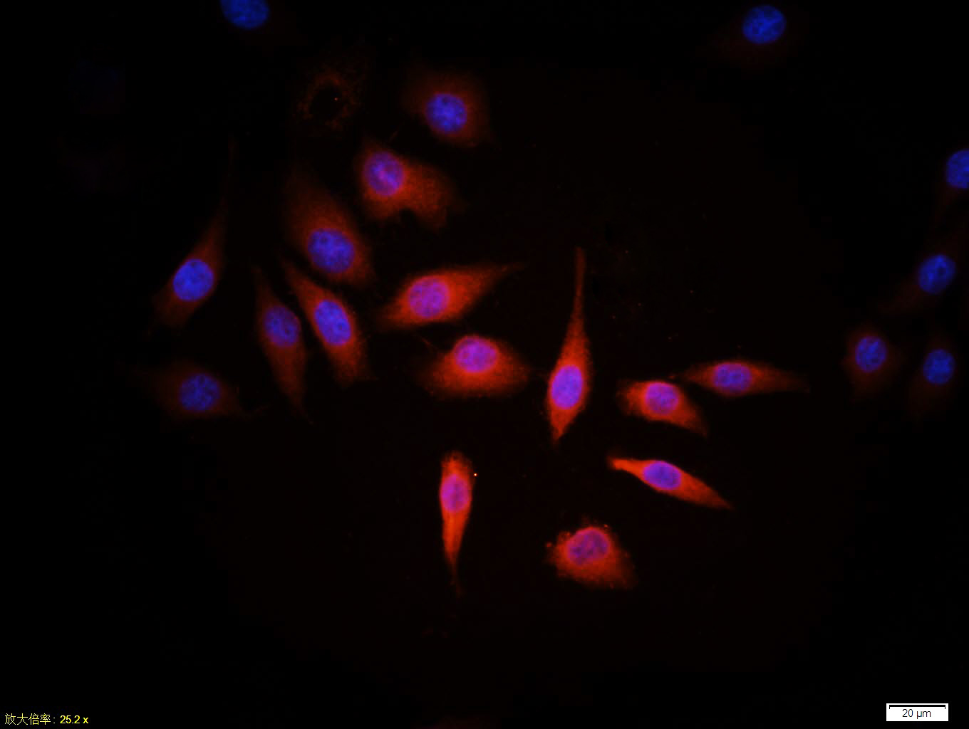 Tissue/cell:MCF7 cell; 4% Paraformaldehyde-fixed; Triton X-100 at room temperature for 20 min; Blocking buffer (normal goat serum, C-0005) at 37°C for 20 min; Antibody incubation with (HER2 receptor) monoclonal Antibody, Unconjugated (bsm-2156M) 1:100, 90 minutes at 37°C; followed by a CY3 conjugated Goat Anti-Mouse IgG antibody at 37°C for 90 minutes, DAPI (blue, C02-04002) was used to stain the cell nuclei. Tissue/cell:MCF7 cell; 4% Paraformaldehyde-fixed; Triton X-100 at room temperature for 20 min; Blocking buffer (normal goat serum, C-0005) at 37°C for 20 min; Antibody incubation with (HER2 receptor) monoclonal Antibody, Unconjugated (bsm-2156M) 1:100, 90 minutes at 37°C; followed by a CY3 conjugated Goat Anti-Mouse IgG antibody at 37°C for 90 minutes, DAPI (blue, C02-04002) was used to stain the cell nuclei.