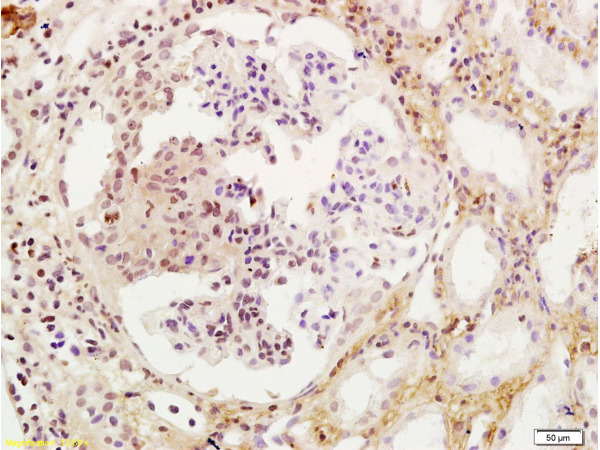 Formalin-fixed and human kidney tissue labeled with Anti-WT-1/Wilms Tumor Protein Polyclonal Antibody, Unconjugated (bs-6983R) at 1:200 followed by conjugation to the secondary antibody and DAB staining
