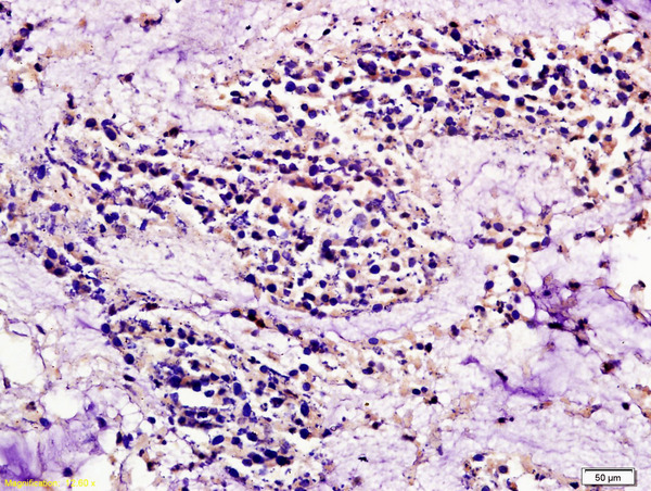 Formalin-fixed and paraffin embedded  human colon carcinoma labeled with Anti CCR7\/CD197 Polyclonal Antibody, Unconjugated (bs-1305R) at 1:200 followed by conjugation to the secondary antibody and DAB staining