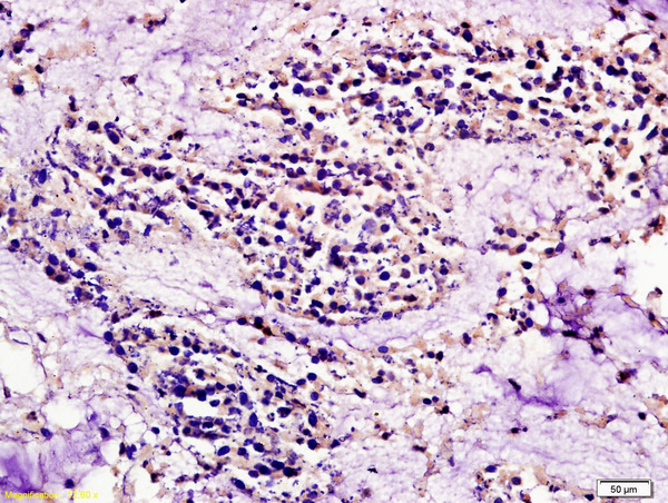 Formalin-fixed and paraffin embedded human colon carcinoma labeled with Anti CCR7/CD197 Polyclonal Antibody, Unconjugated (bs-1305R) at 1:200 followed by conjugation to the secondary antibody and DAB staining