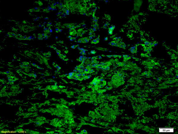 Formalin-fixed and paraffin embedded human gastric carcinoma labeled with Anti CCR7/CD197 Polyclonal Antibody, Unconjugated (bs-1305R) at 1:200 followed by conjugation to the secondary antibody Goat Anti-Rabbit IgG, Cy5 conjugated(bs-0295G-Cy5)used at 1:200 dilution