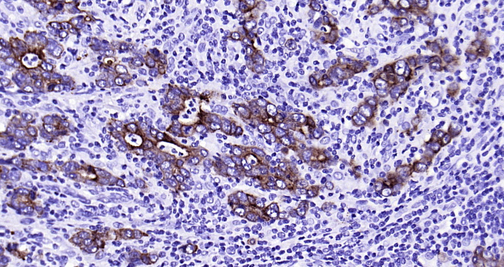 Paraformaldehyde-fixed, paraffin embedded Human gastric carcinoma; Antigen retrieval by boiling in sodium citrate buffer (pH6.0) for 15min; Block endogenous peroxidase by 3% hydrogen peroxide for 20 minutes; Blocking buffer (normal goat serum) at 37°C for 30min; Antibody incubation with CK18 Monoclonal Antibody, Unconjugated (bsm-33103M) at 1:2000 overnight at 4°C, DAB staining.