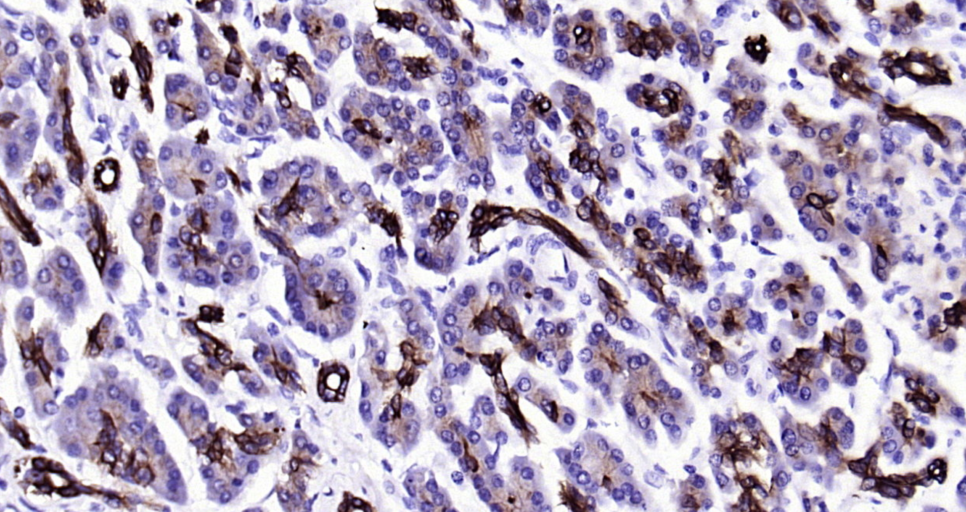 Paraformaldehyde-fixed, paraffin embedded Human pancreatic cancer; Antigen retrieval by boiling in sodium citrate buffer (pH6.0) for 15min; Block endogenous peroxidase by 3% hydrogen peroxide for 20 minutes; Blocking buffer (normal goat serum) at 37°C for 30min; Antibody incubation with CK18 Monoclonal Antibody, Unconjugated (bsm-33103M) at 1:2000 overnight at 4°C, DAB staining.