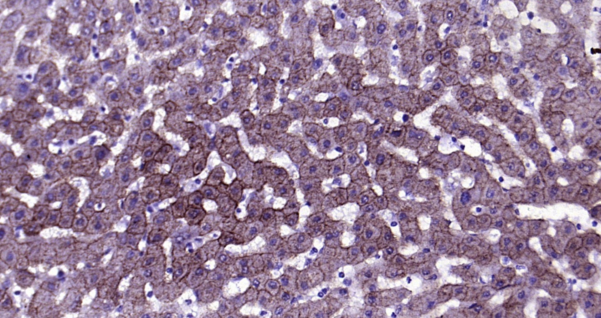 Paraformaldehyde-fixed, paraffin embedded Human liver cancer; Antigen retrieval by boiling in sodium citrate buffer (pH6.0) for 15min; Block endogenous peroxidase by 3% hydrogen peroxide for 20 minutes; Blocking buffer (normal goat serum) at 37°C for 30min; Antibody incubation with CK18 Monoclonal Antibody, Unconjugated (bsm-33103M) at 1:200 overnight at 4°C, DAB staining.