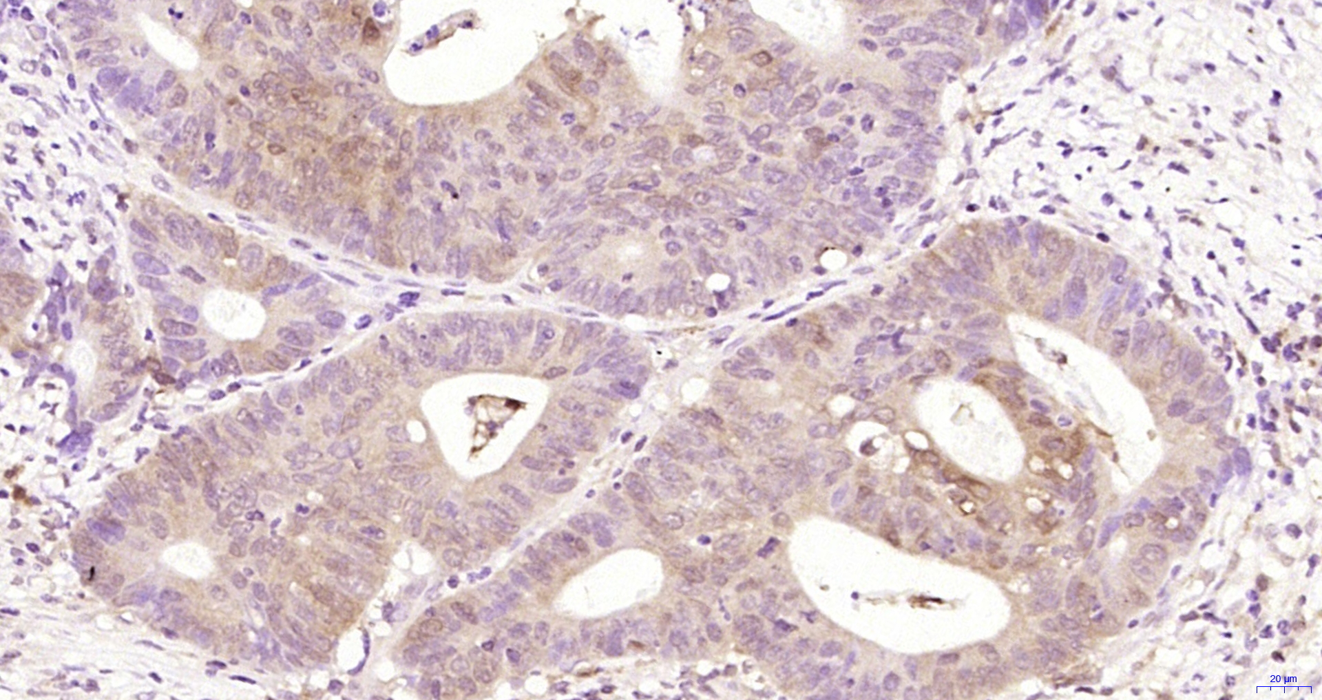 Paraformaldehyde-fixed, paraffin embedded Human colon cancer; Antigen retrieval by boiling in sodium citrate buffer (pH6.0) for 15min; Block endogenous peroxidase by 3% hydrogen peroxide for 20 minutes; Blocking buffer (normal goat serum) at 37°C for 30min; Antibody incubation with _x000D_ Bcl2 Monoclonal Antibody, Unconjugated (bsm-33047M) at 1:200 overnight at 4°C, DAB staining.